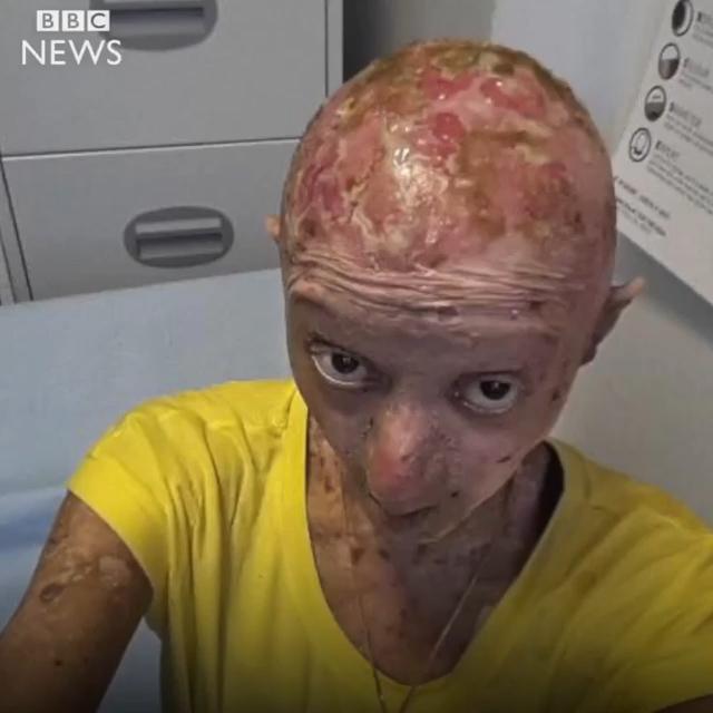  Assya Shabir was born with epidermolysis bullosa, which is a rare genetic condition where her skin is covered in blisters