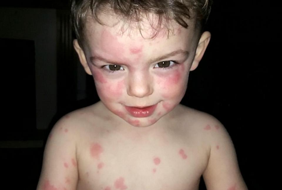 The hot and angry rash breaks out all over his body at least once a month