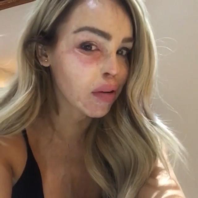  Katie Piper showed her followers her eye infection, revealing she gets them all the time because of her injuries