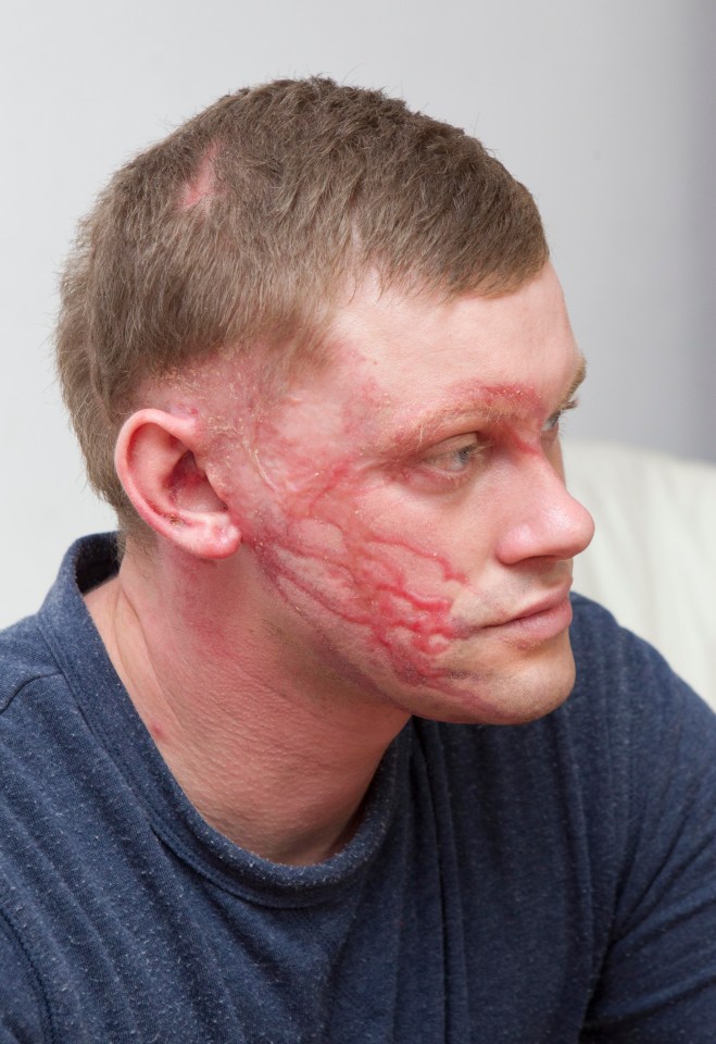 Scarred… Dad Darren was left disfigured by acid attacker