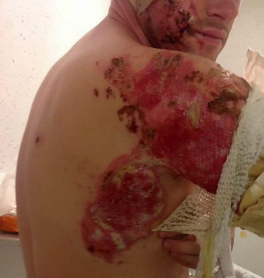 Severe… Skin is easily burned by acid