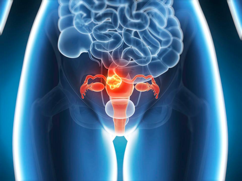  Depending on how advanced the cancer is, a woman may need a hysterectomy to treat it