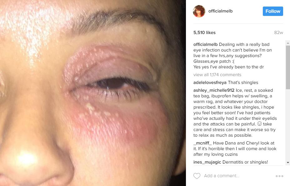  A new document states that Mel lied about the abuse - in 2015 she claimed this injury was from an eye infection