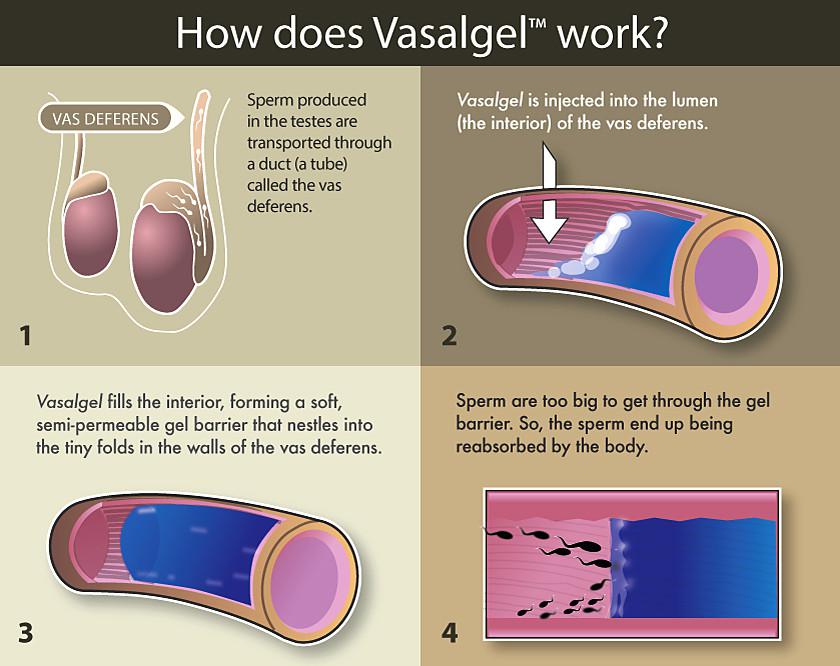  Vasalgel is injected into the vas deferens, the tube that carries sperm to the penis. It blocks the tube, stopping sperm getting through