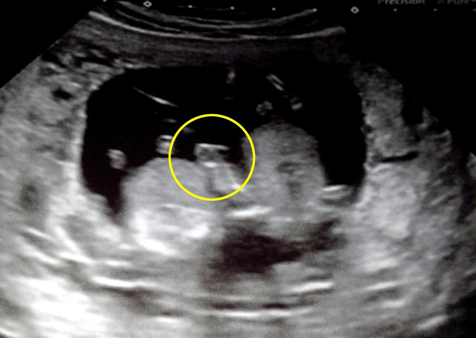  A week before Alfie passed away, Amy had a scan which she believes shows the boys holding hands