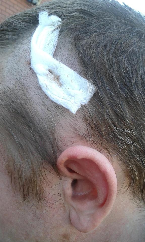  Cheshire Police are on the hunt for the gang after a metal pole was smashed through Chris's skull, just six centimetres from his brain