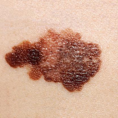 Skin cancer occurs when the skin cells are damaged by UV rays