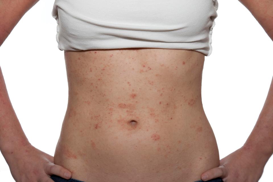 Dermatitis can cause red, itchy patches to appear all over the body