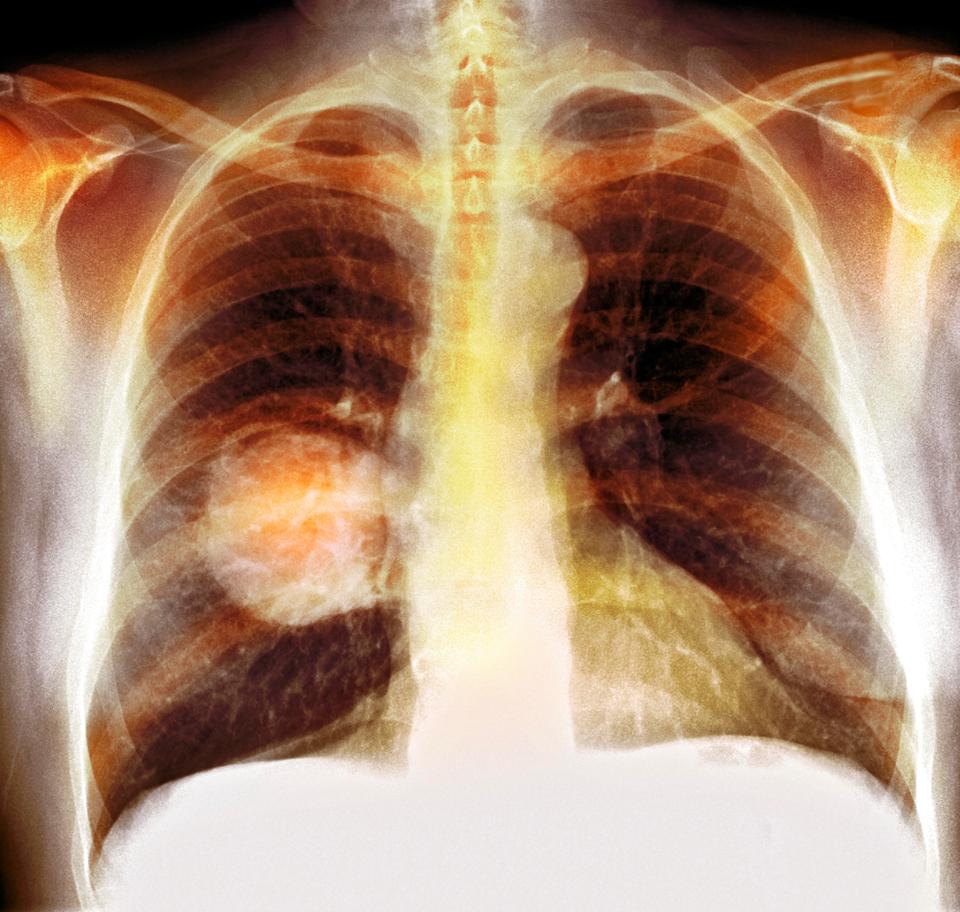 A new blood test can show if cancer will return a year before it appears on X-rays or CT scans