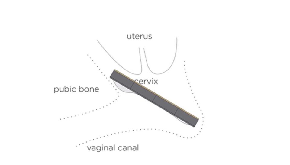  A diagram showing how Flex is worn high up in the vagina, covering the cervix so it stops fluids from entering the vaginal canal