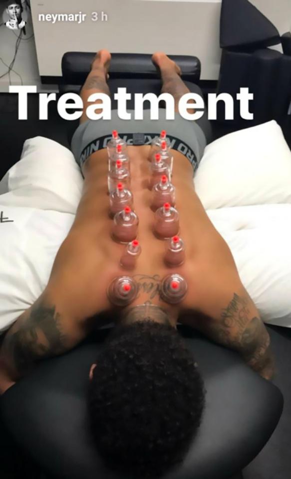  Neymar is another player who has benefited from the cupping treatment