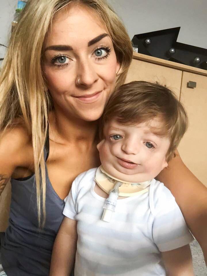 Little Loui, pictured with his mum Karly, suffers a rare condition called Treacher Collins syndrome