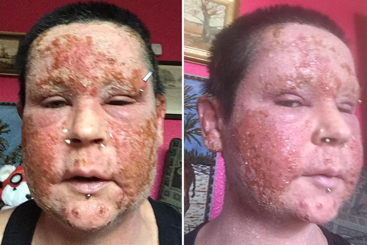 Samantha Ford was left with horrific sores over her face