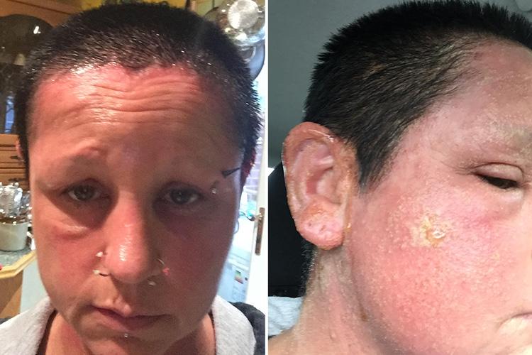  The Stourport-on-Severn local said that she had to go to the doctor's several times as she desperately tried to have her skin return to normal