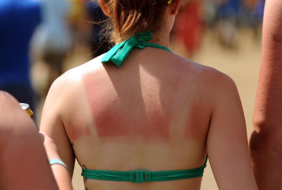  A woman suffers from sunburn during the 2009 Glastonbury Festival