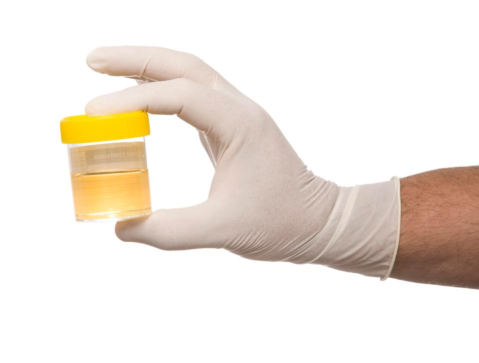  AN STI test requires you to give a sample of wee at a sexual health clinic