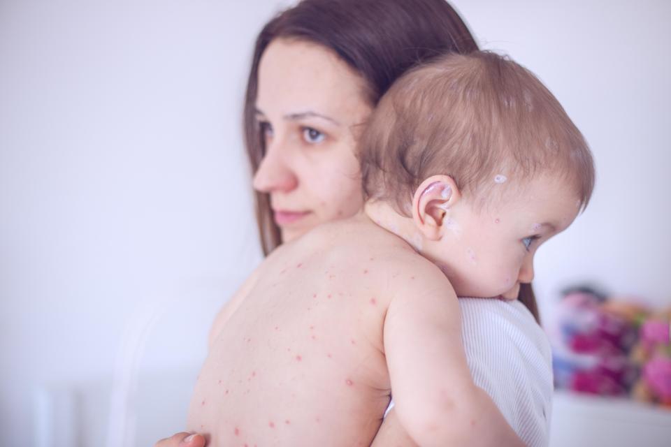 Ibuprofen does not make chicken pox worse, but can increase the risk of bacterial infections in children with the illness