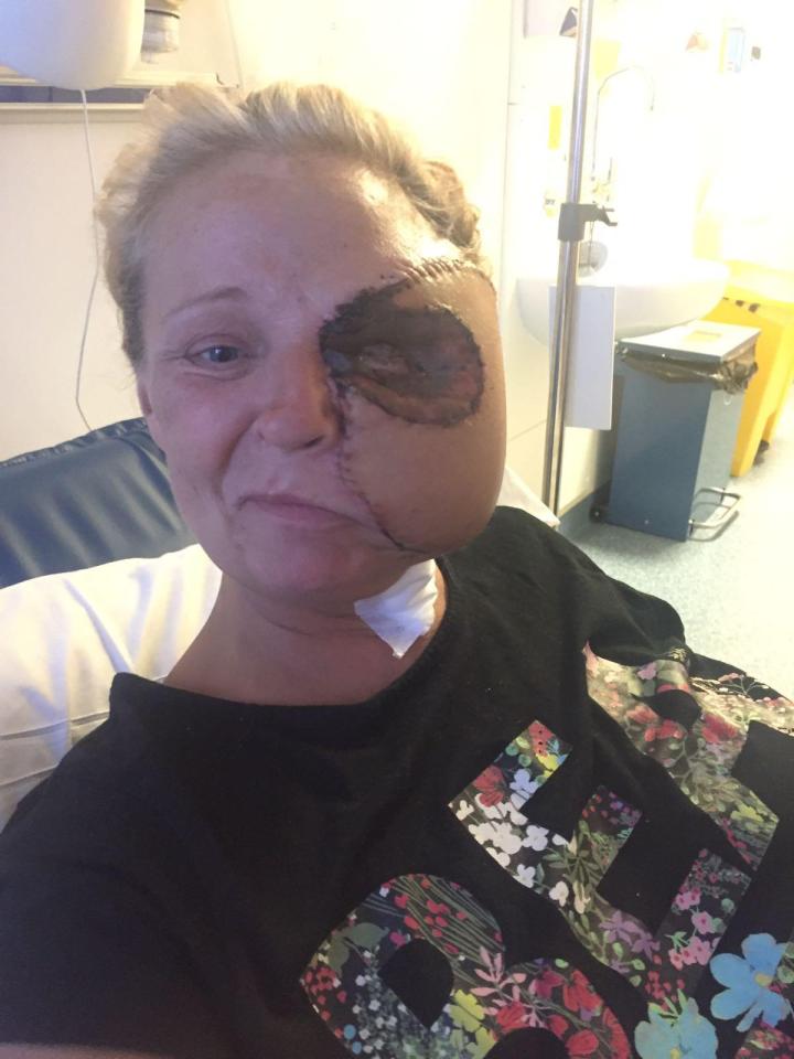  Donna Corden, from Leeds, almost died after a tiny cut on her eye brow became infected with the bug