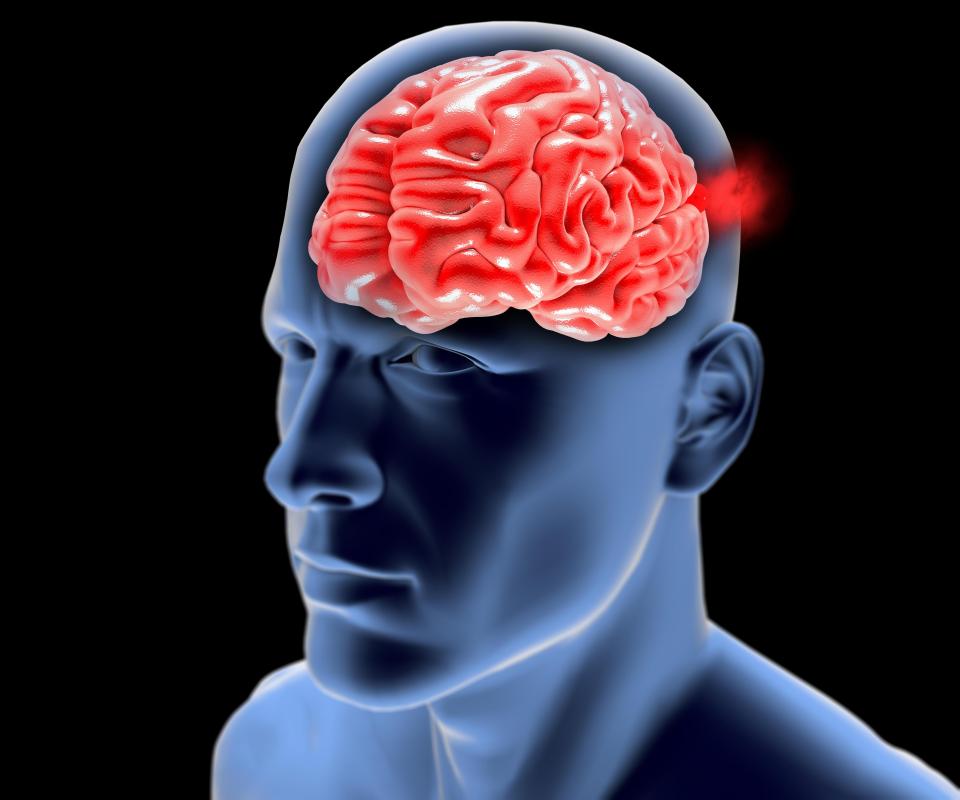  If the aneurysm ruptures, bleeding can cause extensive brain damage and possibly death