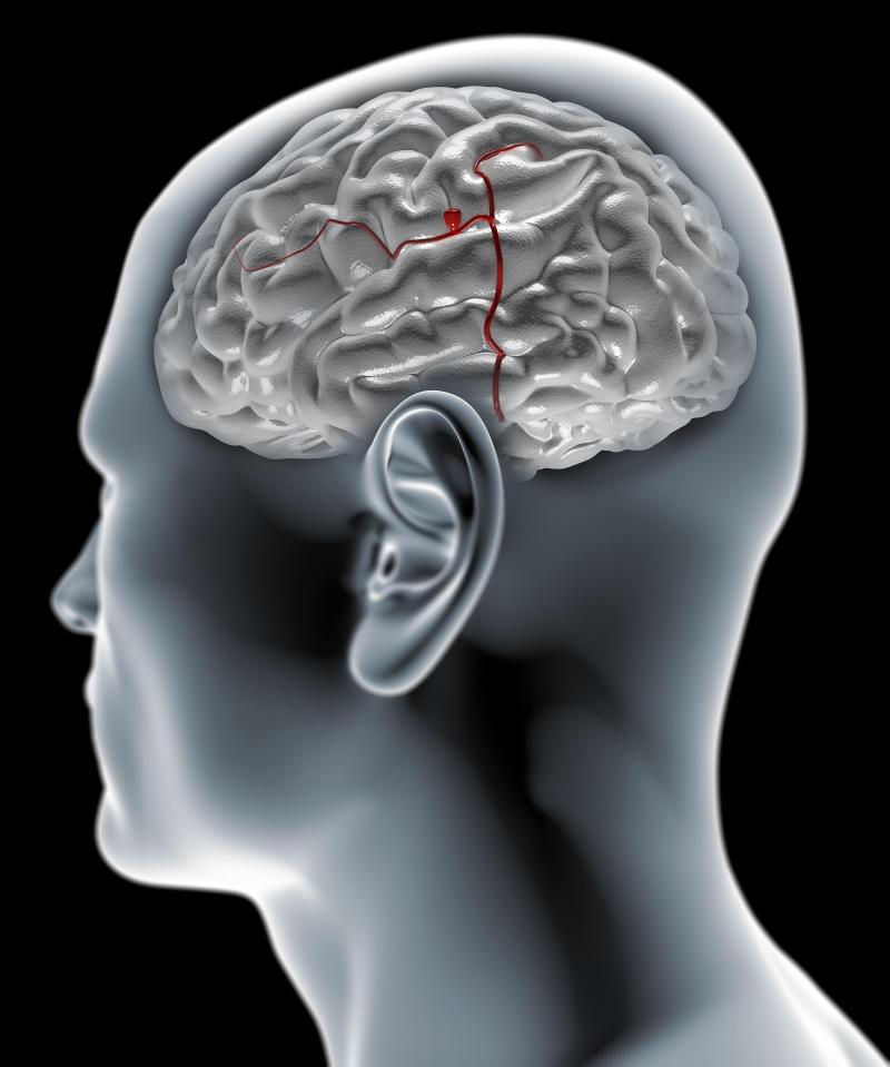  A brain aneurysm occurs when there is a bulge in a weakened blood vessel