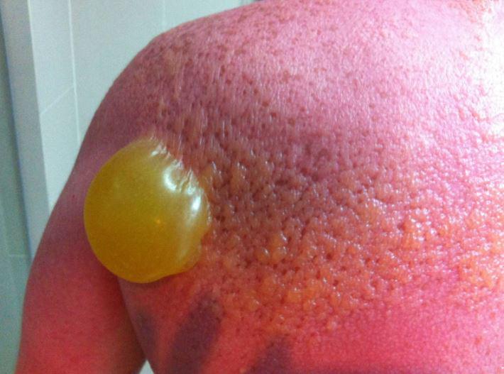  Sunburned tourists have been sharing pictures of their blistered skin online as a warning to others