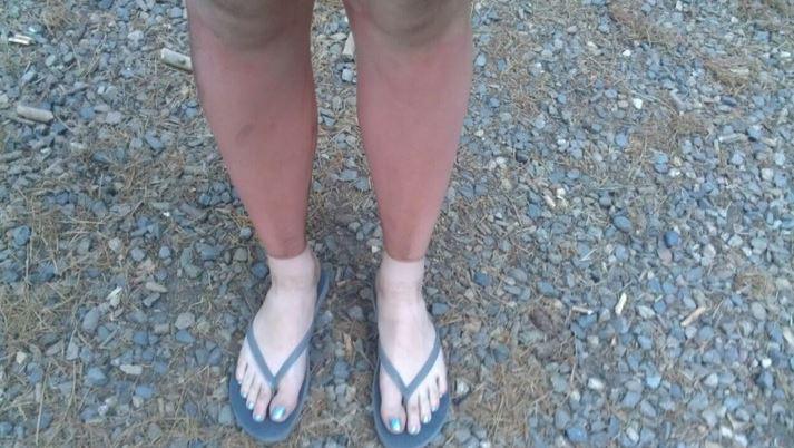  In other incidents, odd tan lines result in some strange appearances, like this photo of a woman who got sunburned on a long hike while wearing boots