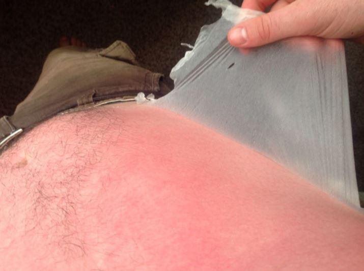  This burn is so bad that a whole sheet of skin can be pulled off