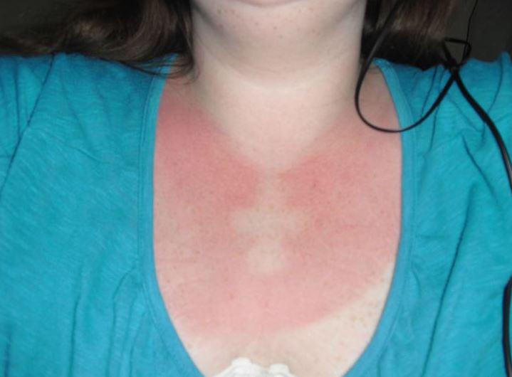  This woman was left with a religious symbol imprinted on her chest after getting burned while wearing a cross necklace