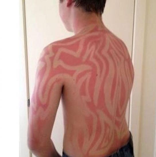  In other cases, holidaymakers have attempted sunburn tattoos by being creative with their exposure