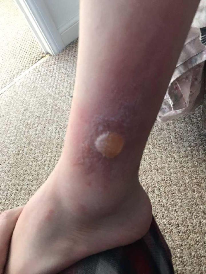 Huge painful blisters erupted on Adam Hodgson's skin after coming into contact with the poisonous weed