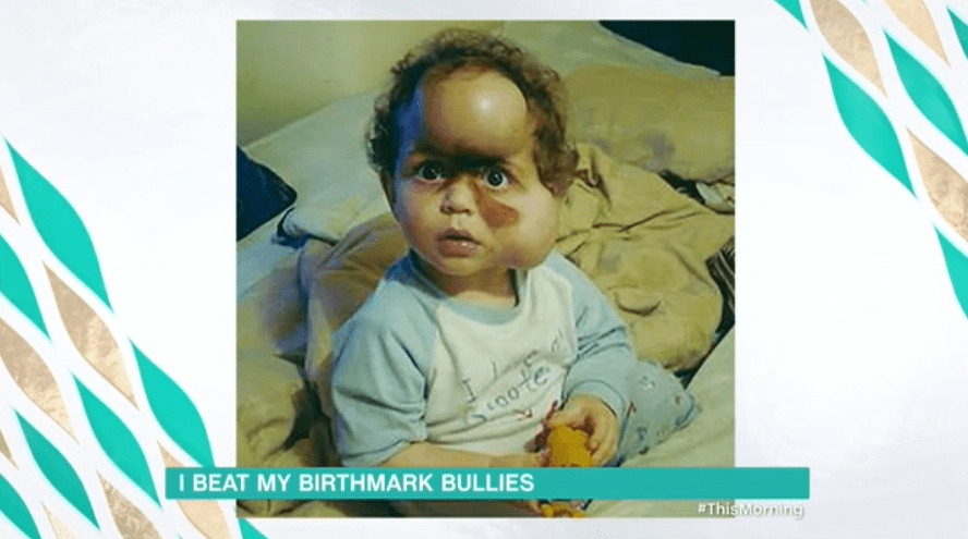  He was born with a rare facial birthmark that only affects one in 500,000 people