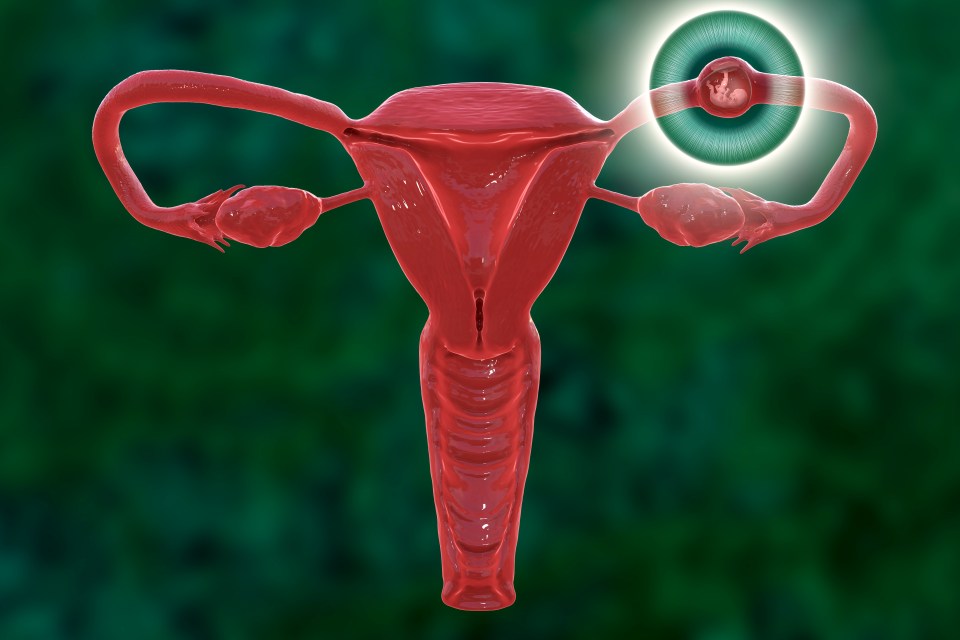  The fertilised egg implants outside of the womb, usually in a fallopian tube, where the baby starts to grow