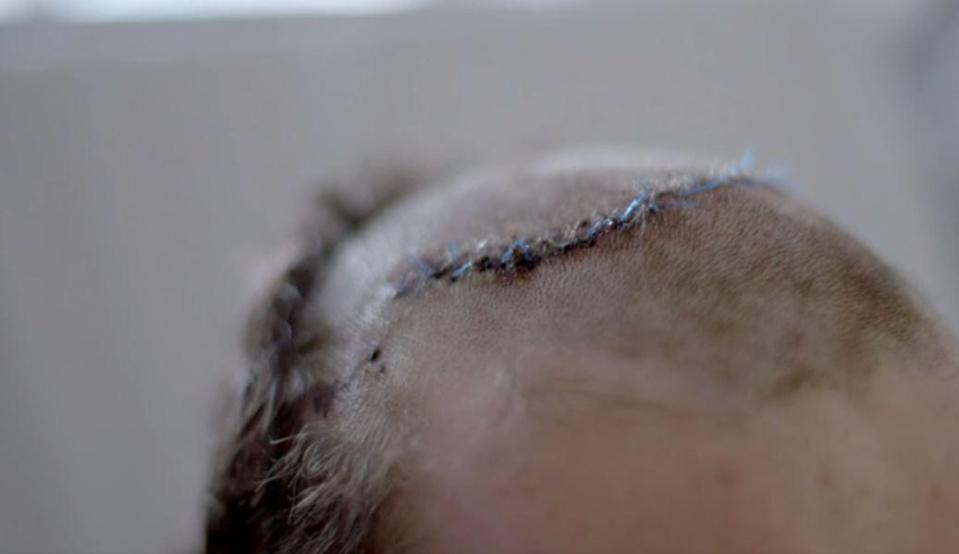  Among the victims was French student Yann, 18, who had to have his scalp sewn back together