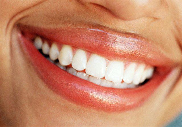  Teeth whitening is not a one-off procedure and will need repeating to maintain a constantly bright look