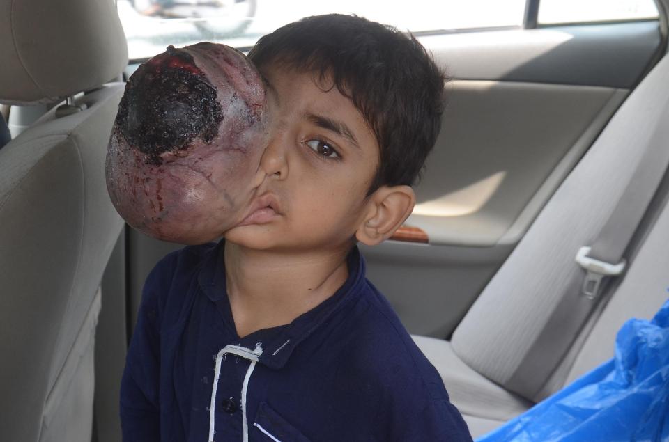 Ali Hassan was diagnosed with Neuroblastoma cancer earlier this year and had to have his right eye removed