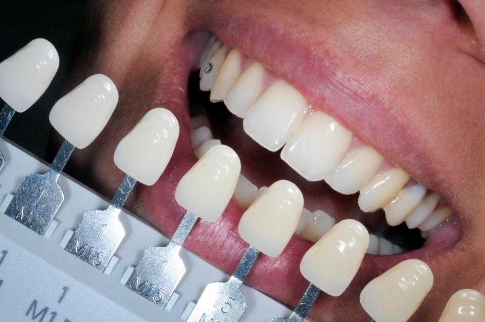  Teeth can become stained from tea and coffee