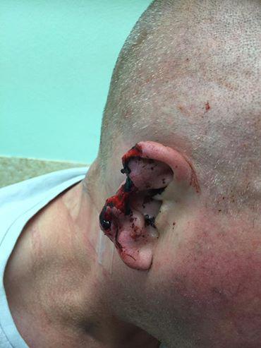  Alastair required surgery following the attack which saw a large chunk of his ear bitten off