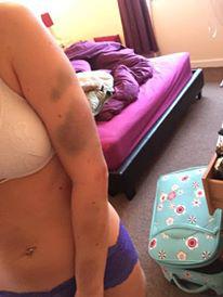  Kelly was left a 'trembling wreck' after Barrow beat her 'for hours on end', pictured showing her injuries