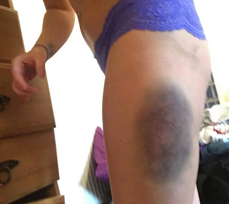  Kelly was left black and blue after being violently assaulted by Barrow over a three-day period