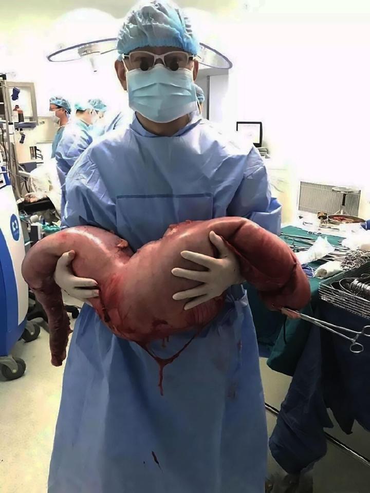  Surgeons in China have removed 30 inches of a man's bowel after a rare condition left him constipated for years