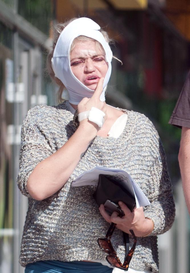  The actress was seen looking swollen and bruised in the days after the operation in Poland