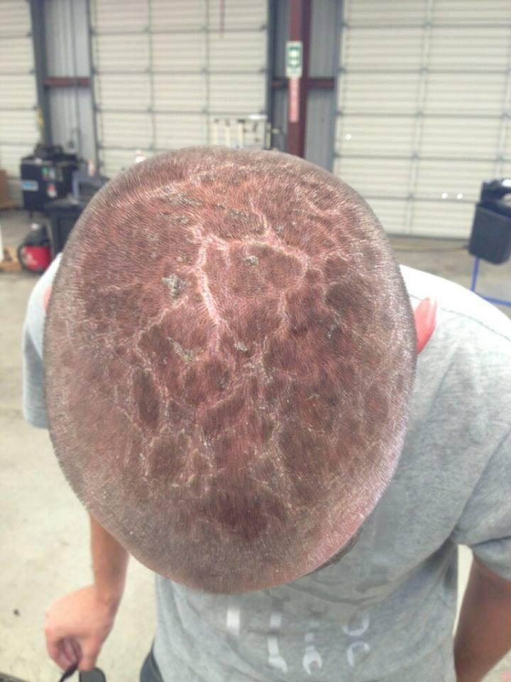 A young man shows off a sore and cracked scalp after spending too long in the sun without enough protection