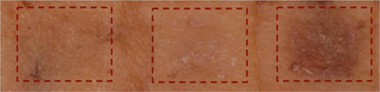  The drug was tested on the skin sample on the right and successfully produced a darker colour in the skin