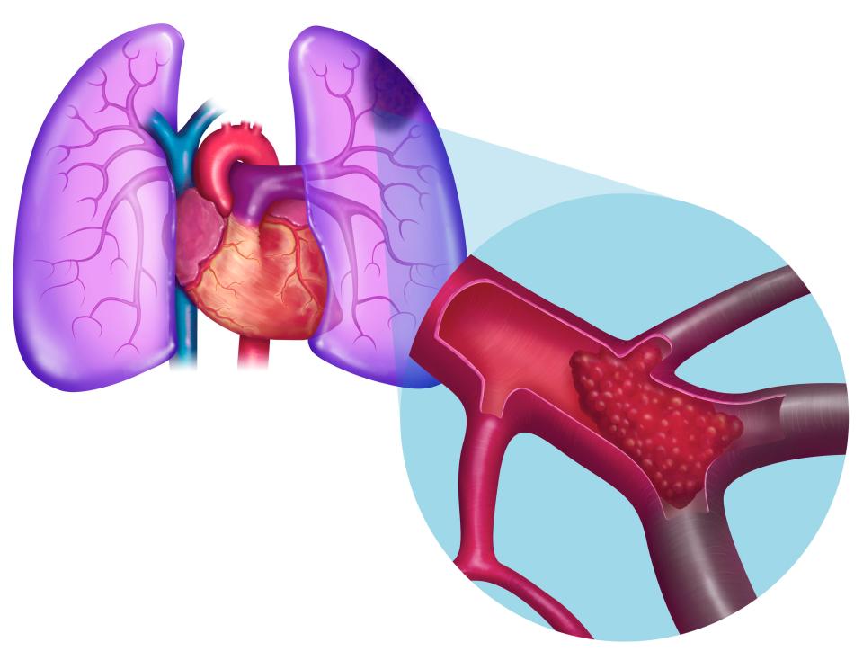  A pulmonary embolism