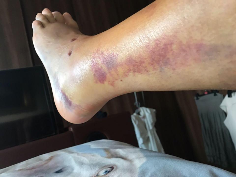  The 40-year-old has claimed that after her accident at the Oxygen Freejumping Trampoline Park - staff joked "she was on drugs" when she came around