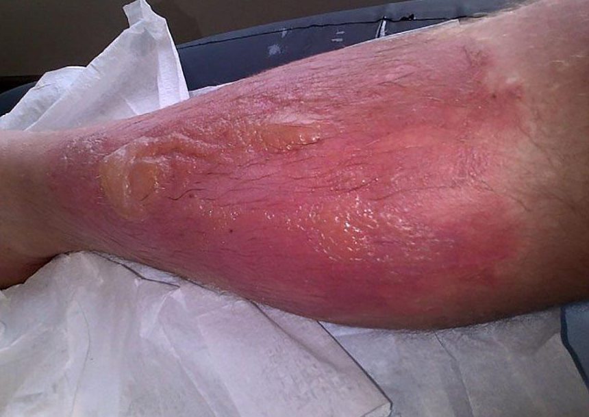  Horticulturist Dean Simmons was left in agony after brushing against a giant hogweed