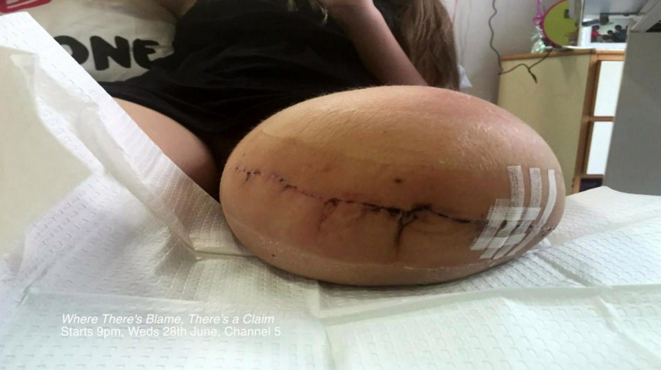 The teen's left leg was so badly crushed doctors amputated it below the knee