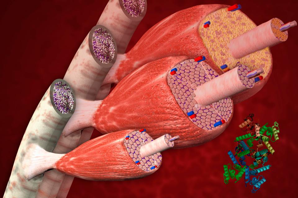  A graphic showing how the muscles of muscular dystrophy sufferers begins to shrink