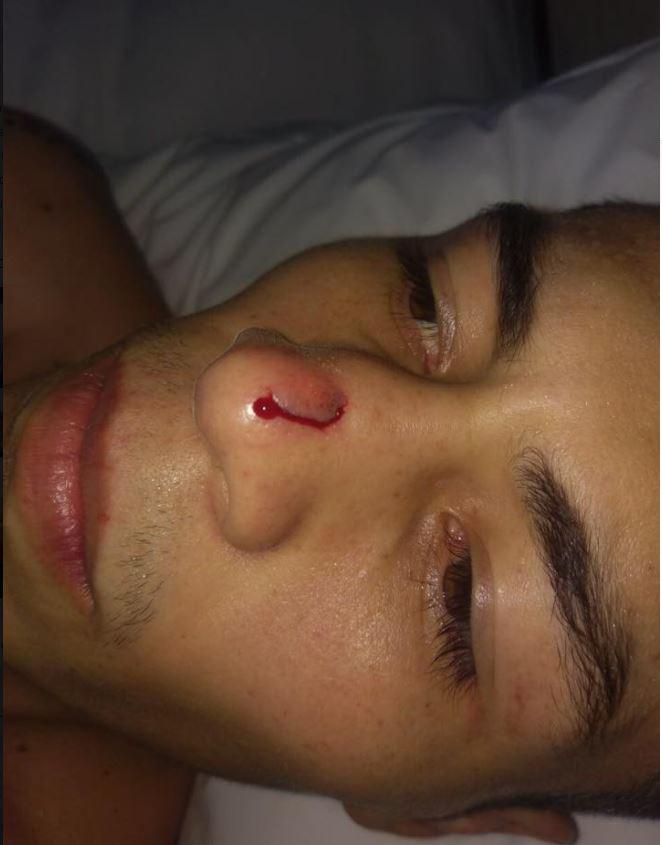 Andres Gutierrez shared photos of his injuries on his Facebook page that means his fight against Carl Frampton is off