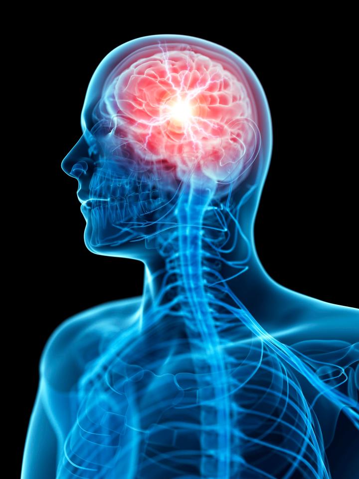 And shingles patient were also 35 per cent more likely to suffer a blood clot on the brain, causing a stroke